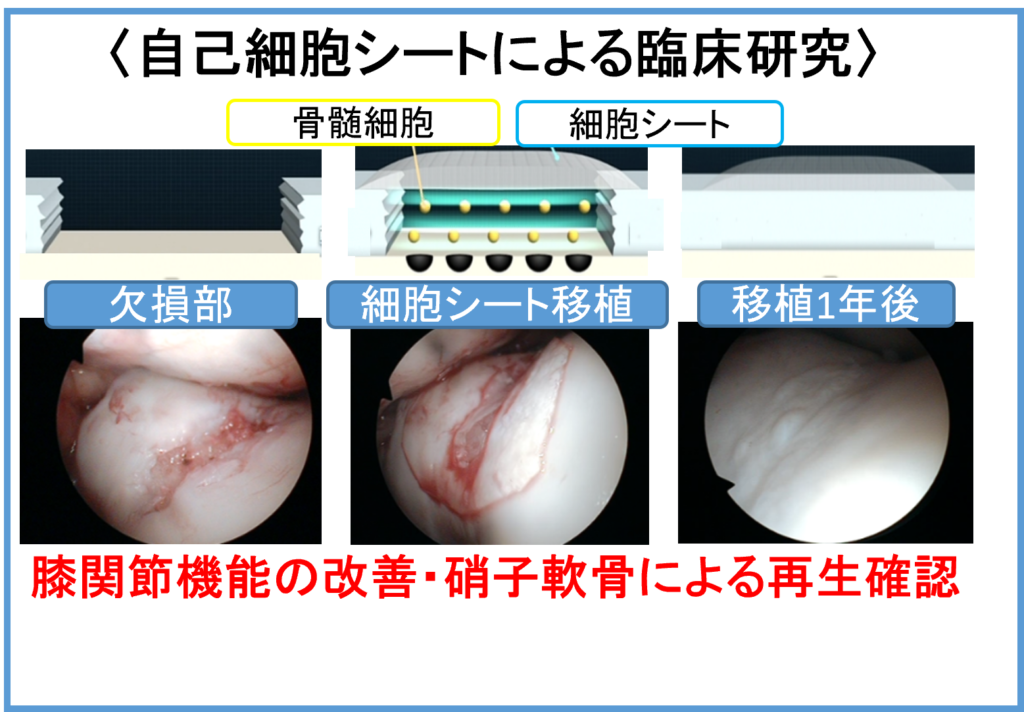 自己細胞シートによる臨床研究